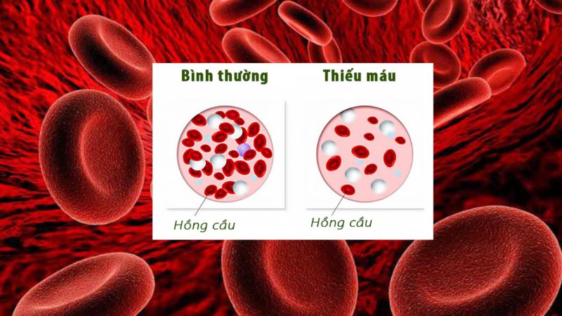 Thiếu máu do thiếu Vitamin B12 ở người lớn