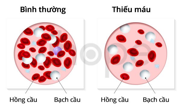 Thiếu máu do thiếu men Pyruvate Kinase