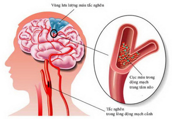 Thiếu máu não cục bộ