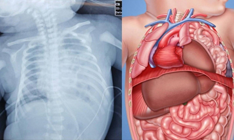 Hình ảnh minh họa thoát vị hoành gây thiểu sản phổi
