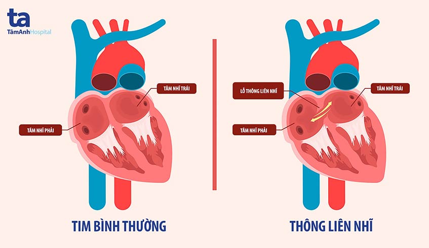 Hình ảnh thông liên nhĩ