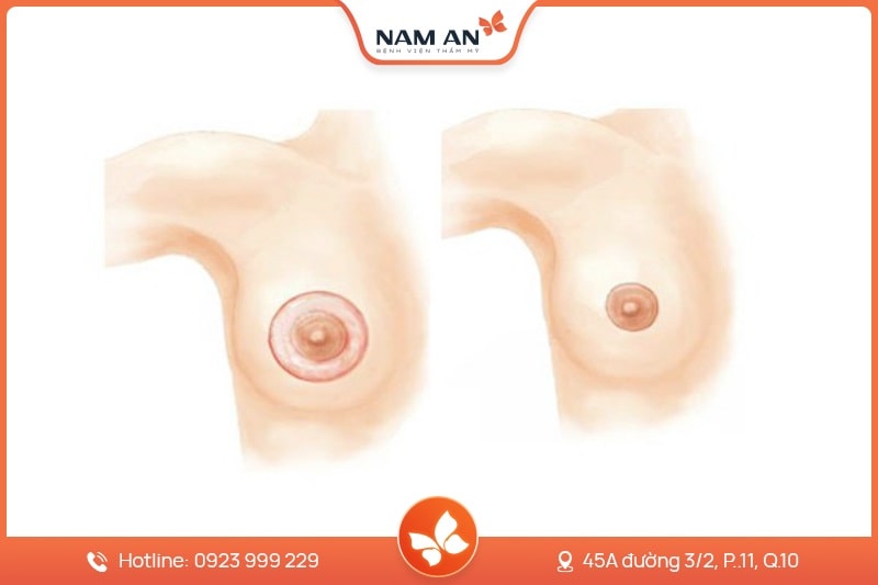 Quy trình thu nhỏ quầng vú, đầu ti thực tế