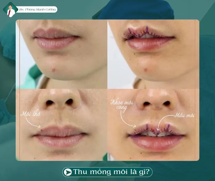 Môi dày mất cân đối