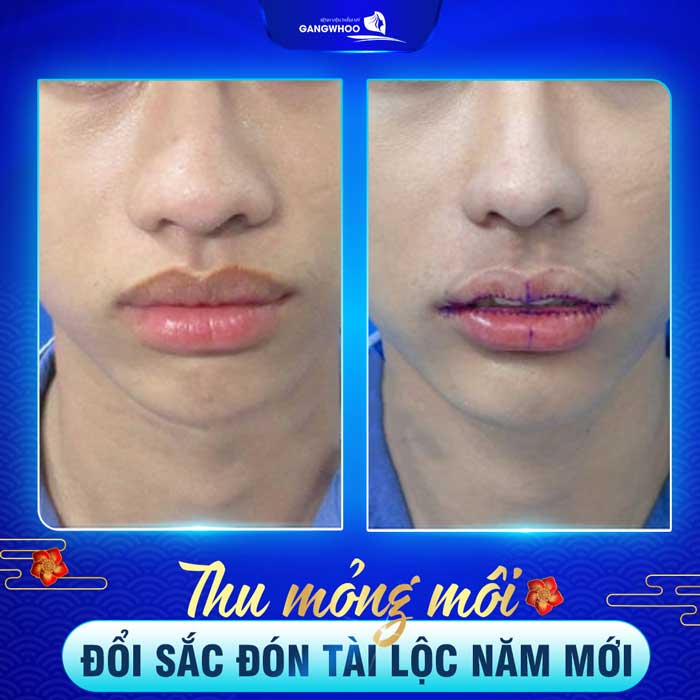 Làm mỏng môi - trước và sau