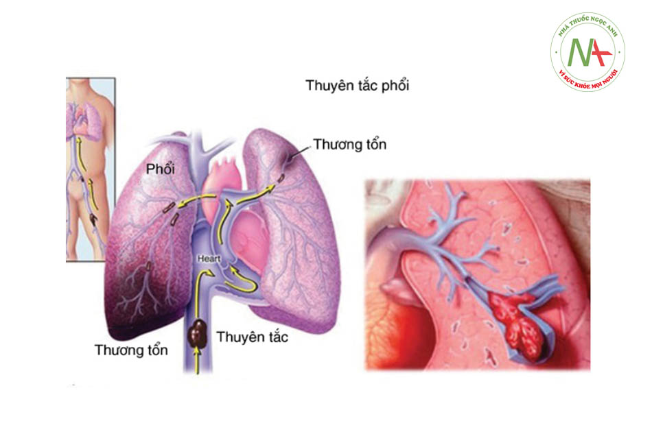 Thuyên tắc phổi