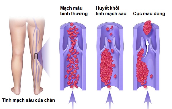 Huyết khối sau sinh gây thuyên tắc phổi