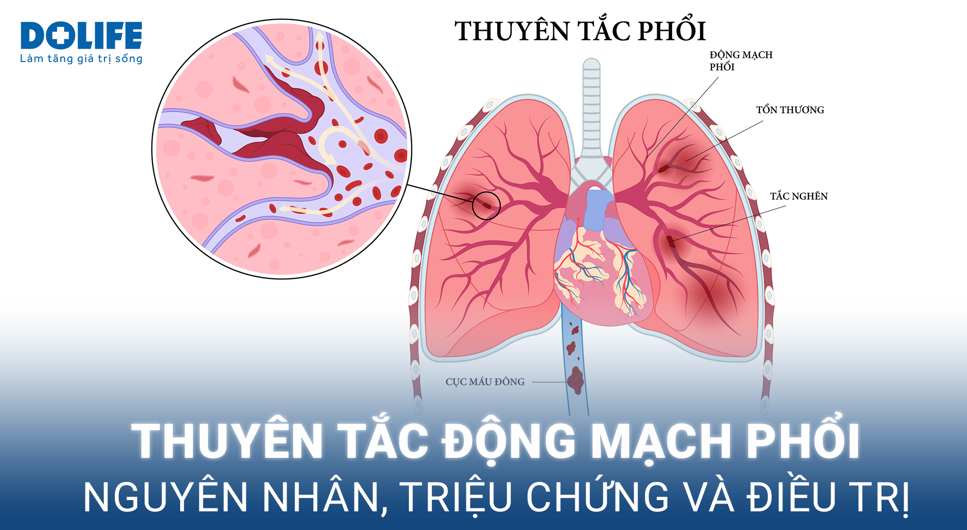Thuyên Tắc Phổi: Hiểm Họa Tức Thời Từ Huyết Khối Âm Thầm 8 CT scan cho thấy thuyên tắc động mạch phổi