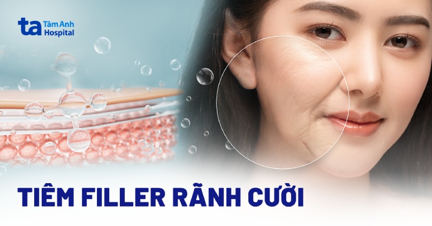 Hiệu quả sau tiêm filler rãnh cười