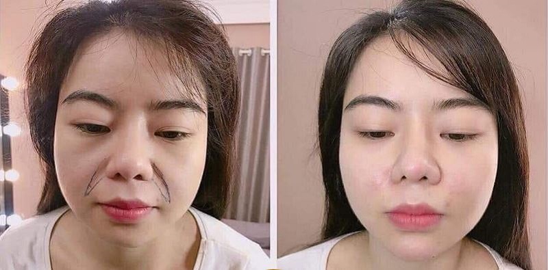 Hình ảnh tiêm filler vùng rãnh cười