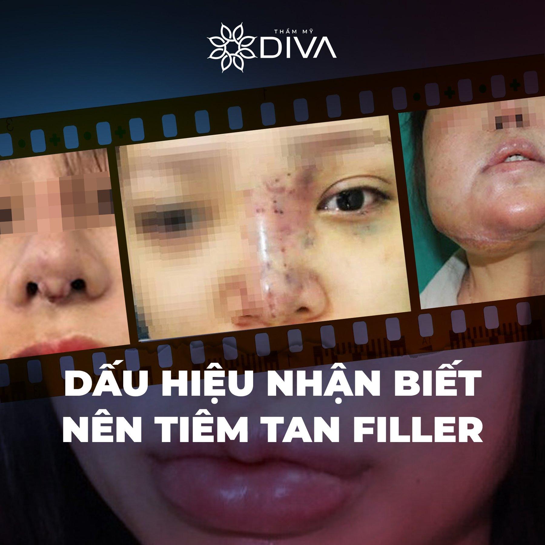 Filler bị lệch và vón cục cần tiêm tan