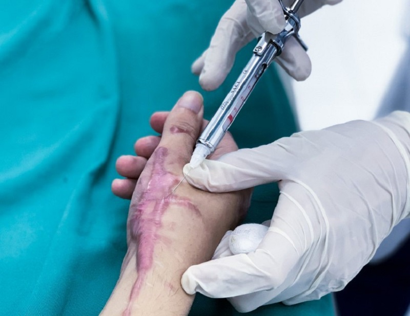 Tiêm corticoid trị sẹo lồi