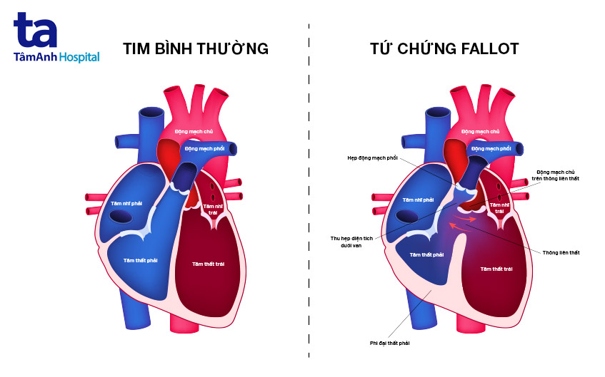 Tứ chứng Fallot tim bẩm sinh