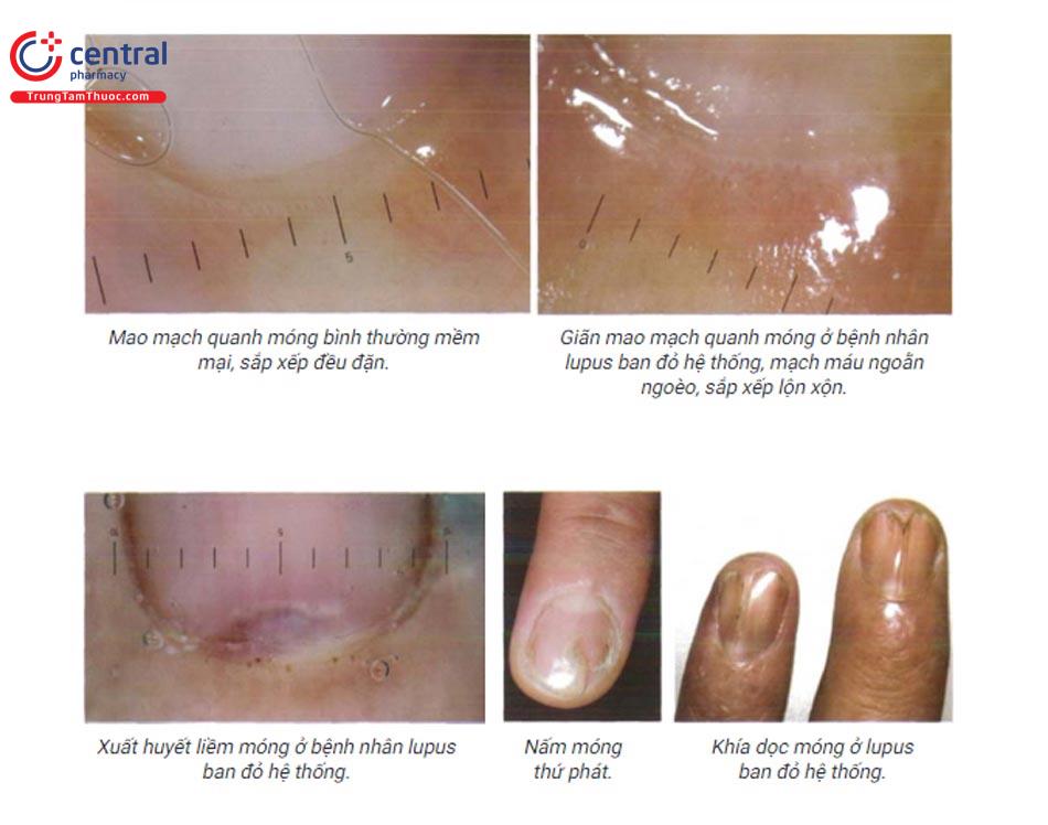 Các bệnh móng liên quan đến xuất huyết dạng dăm