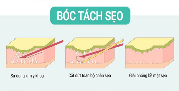 Tách sẹo rỗ (bóc tách đáy sẹo): Bước quan trọng trong điều trị sẹo 8 Hình ảnh quy trình bóc tách đáy sẹo