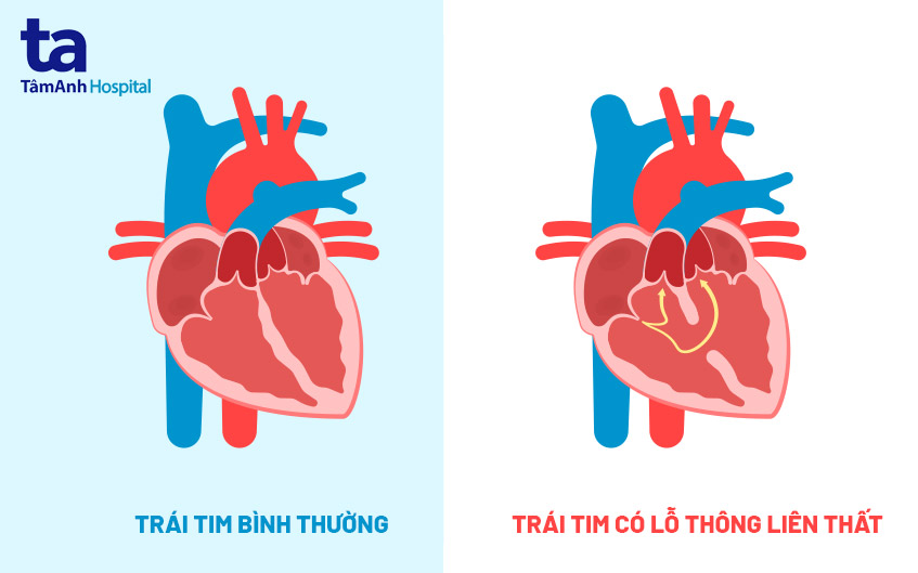 Thông liên thất (VSD): Dị tật tim bẩm sinh phổ biến ở trẻ nhỏ 7 sơ đồ thông liên thất