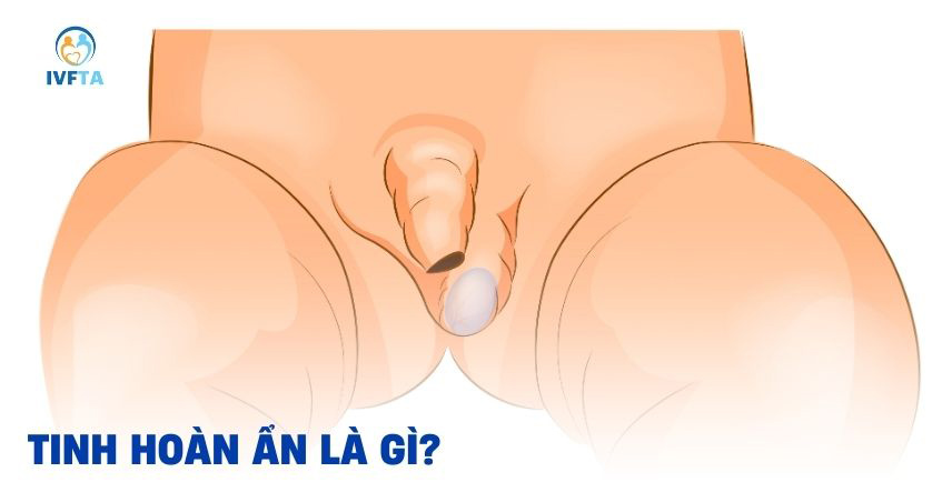Nội soi phát hiện tinh hoàn ẩn