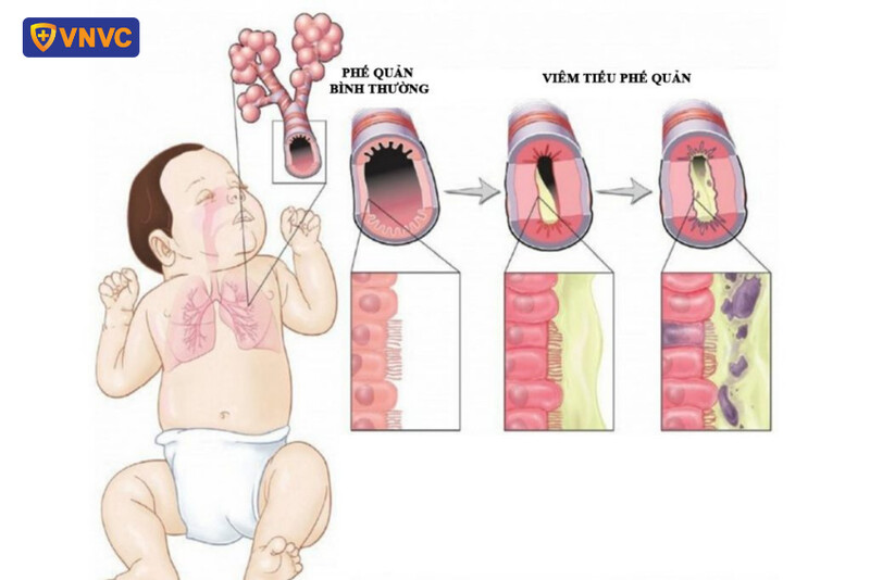 Hình ảnh minh họa viêm tiểu phế quản tắc nghẽn