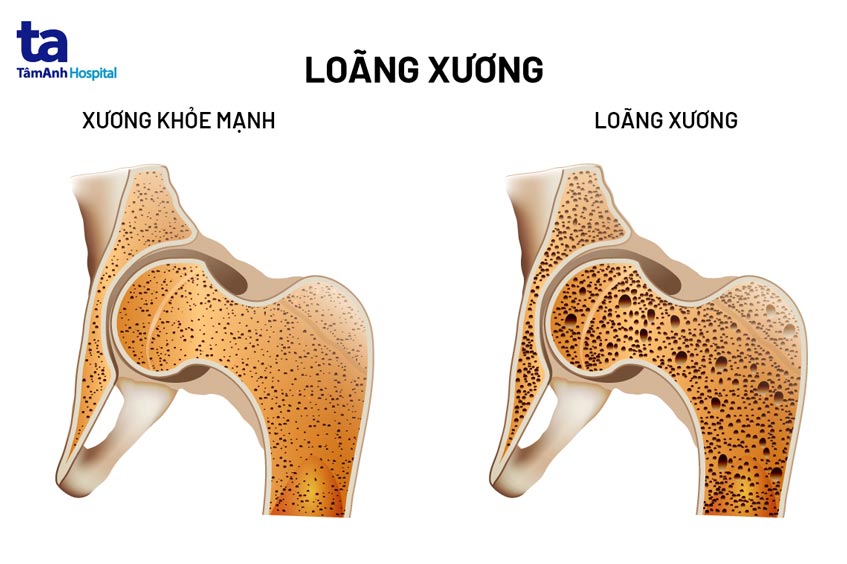 Loãng Xương Sau Mãn Kinh: Hiểu Rõ Nguyên Nhân, Triệu Chứng và Hướng Điều Trị Hiệu Quả 7 Tình trạng xốp xương ở phụ nữ sau mãn kinh