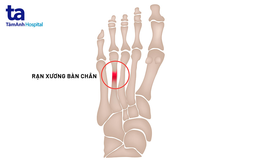 Rạn xương là gì? Triệu chứng, phân biệt và cách điều trị hiệu quả 7 Hình ảnh rạn xương bàn chân