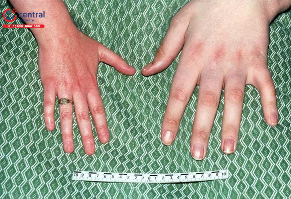 Phì đại mô mềm và nguy cơ tổn thương tim ở người bệnh Acromegaly