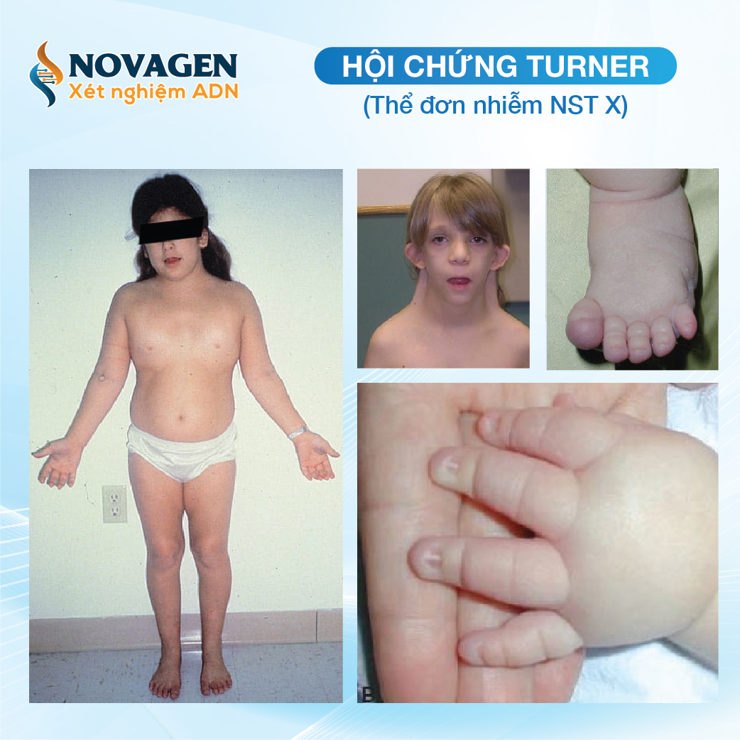 bất thường NST giới tính