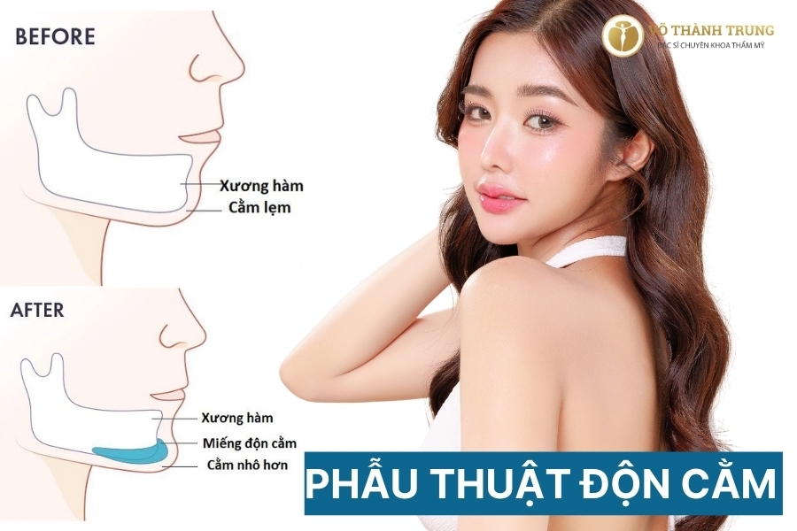 Tổng quan về độn cằm V-line
