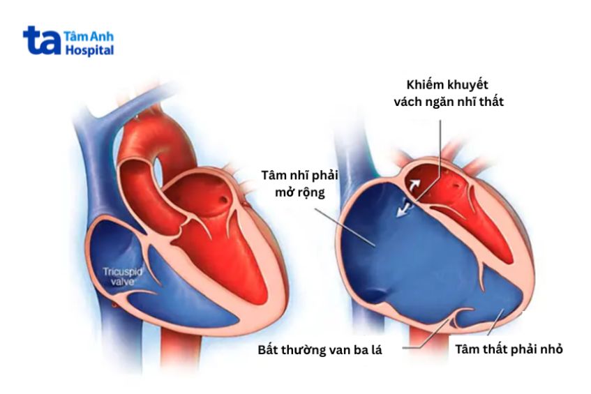 Hình ảnh trái tim mắc dị tật Ebstein