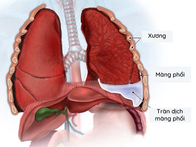 Hình ảnh tràn dịch màng phổi do xơ gan