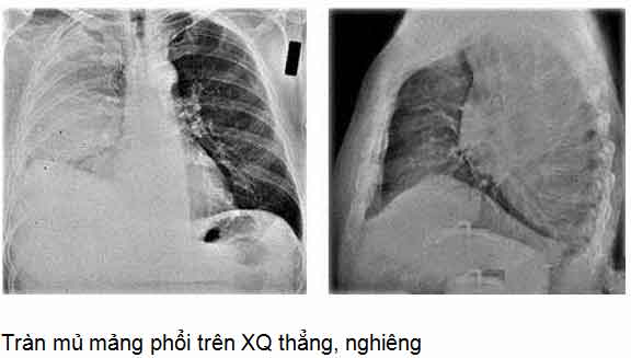 Hình ảnh tràn mủ màng phổi trên phim X-quang