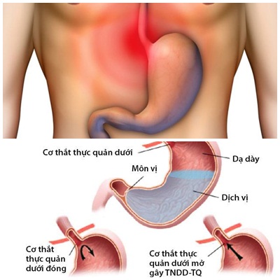 Trào ngược dạ dày gây đau xương ức