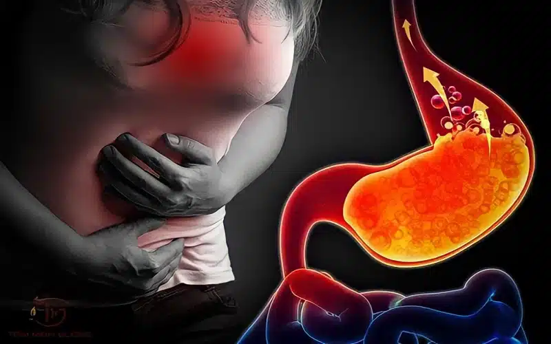 Ợ Nóng: Nguyên Nhân, Triệu Chứng và Cách Điều Trị Hiệu Quả 8 Trào ngược dạ dày thực quản gây ợ nóng
