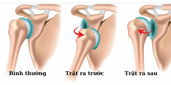 Hình ảnh minh họa trật khớp