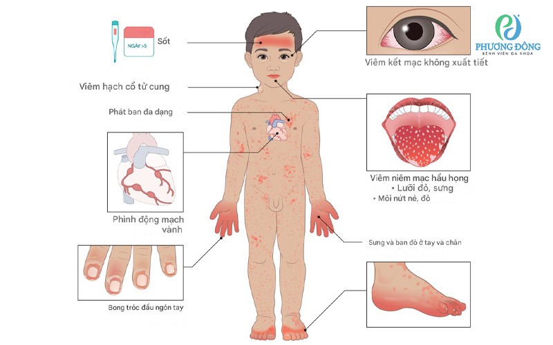 Bệnh Kawasaki và biến chứng phình động mạch vành: Hiểu đúng để điều trị hiệu quả 7 Trẻ bị bệnh Kawasaki có nguy cơ biến chứng mạch vành