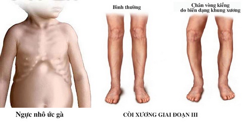 Trẻ bị còi xương do thiếu vitamin D