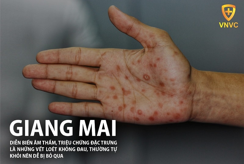 Bệnh giang mai: Căn bệnh nguy hiểm nhưng có thể chữa khỏi nếu phát hiện sớm 7 Triệu chứng bệnh giang mai