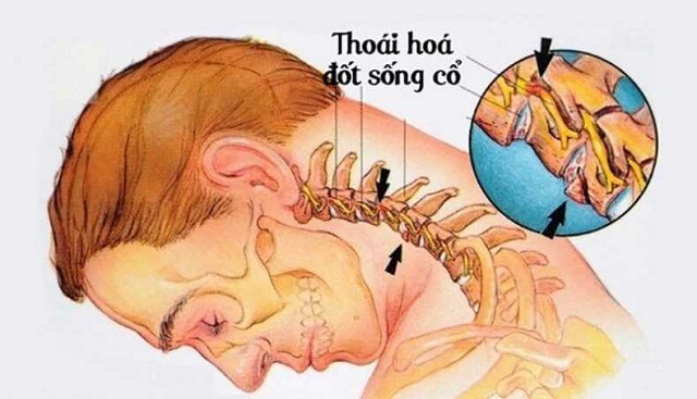 Triệu chứng đau cổ vai gáy