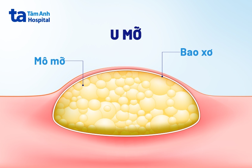 Triệu chứng bệnh u mỡ