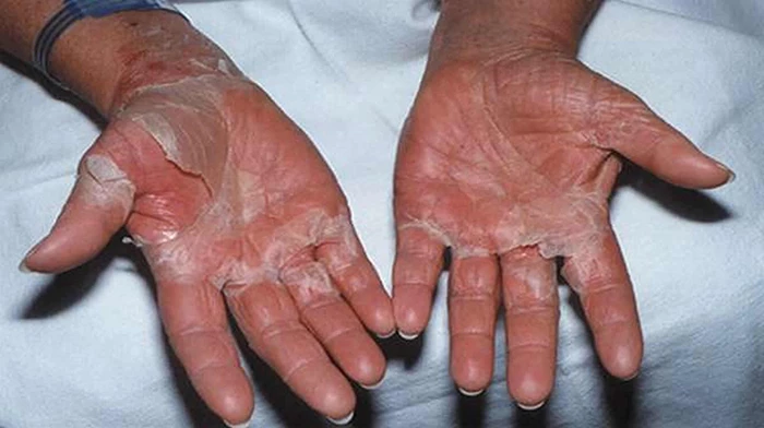triệu chứng hội chứng sốc nhiễm độc do tụ cầu