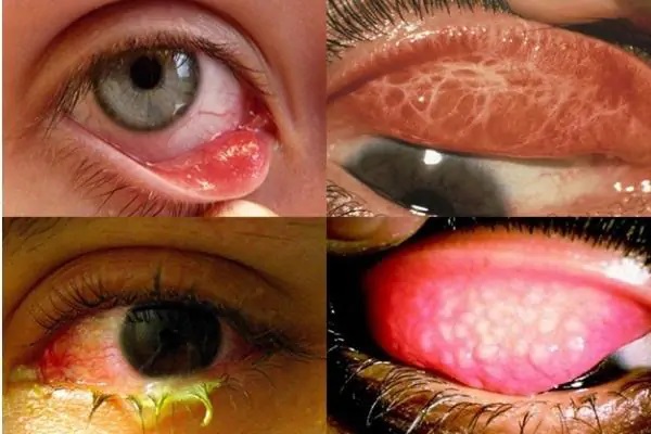 Mắt đỏ, cộm do mắt hột