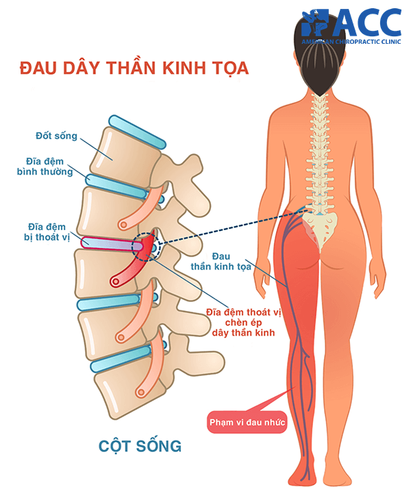 Triệu chứng đau dây thần kinh tọa