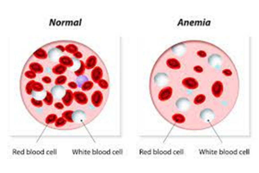 Triệu chứng thiếu máu ở bệnh nhân Thalassemia
