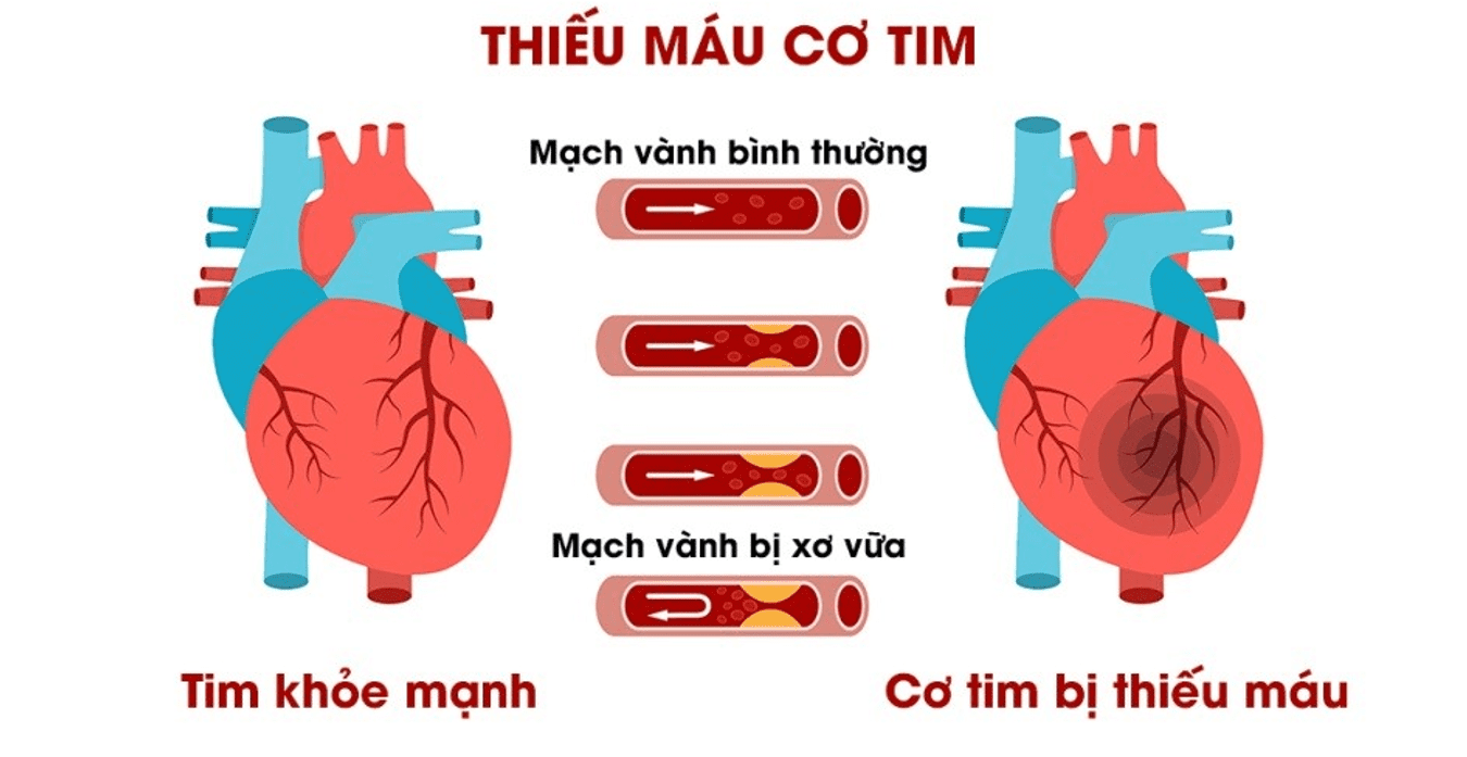 Hội Chứng Vành Cấp: Hiểu Đúng Để Điều Trị Kịp Thời 8 triệu chứng thiếu máu cơ tim