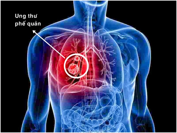 Triệu chứng ung thư phế quản