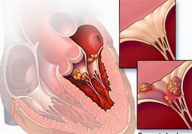 Triệu chứng bệnh tim do thấp