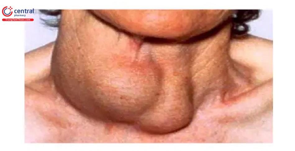 Triệu chứng viêm tuyến giáp bán cấp