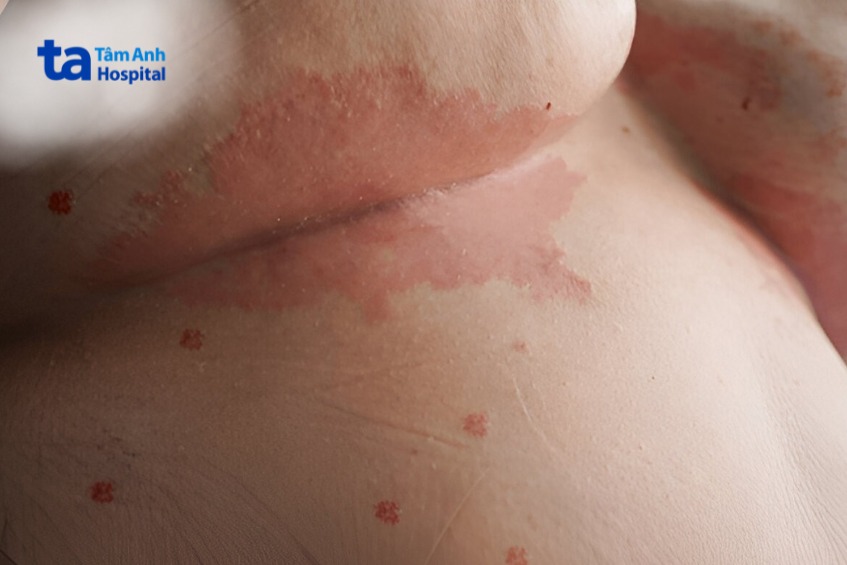 Triệu chứng vảy nến thể đảo ngược vùng bẹn
