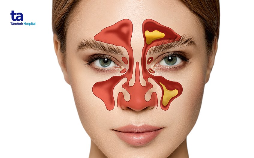 Triệu chứng đau đầu do viêm xoang