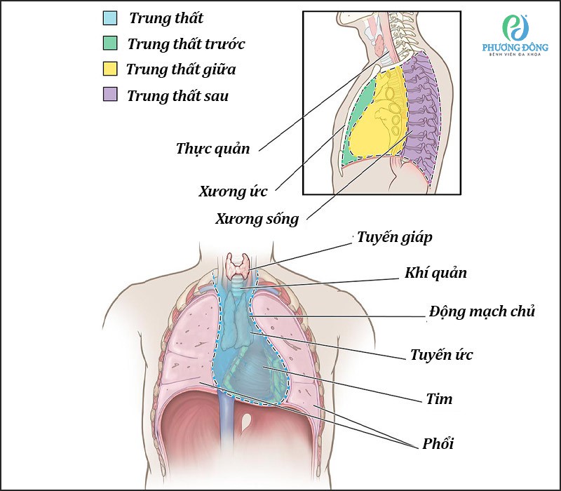 Hình ảnh trung thất bị xơ hóa - BV Phương Đông