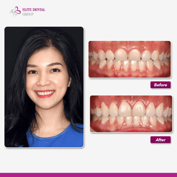 Trước và sau điều trị cười hở lợi