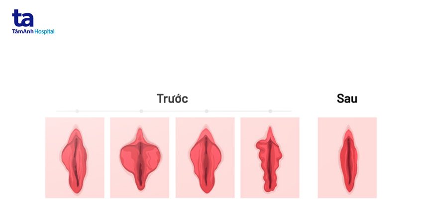 Hình ảnh trước và sau phẫu thuật thu nhỏ môi bé